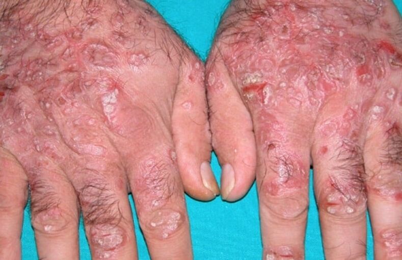 tearful psoriasis on the hands
