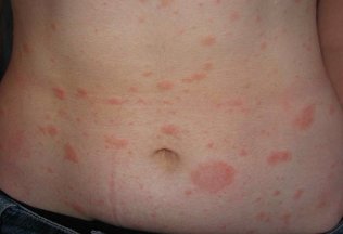 More psoriasis treatment of the body