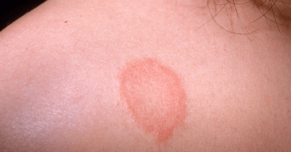 initial stage of psoriasis