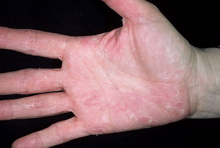 psoriasis of the palms and soles