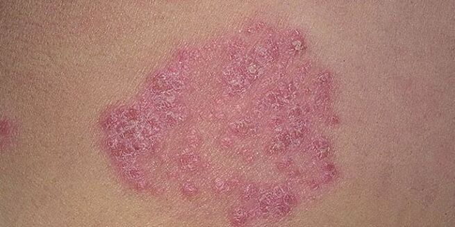 papule on the skin of the feet with psoriasis