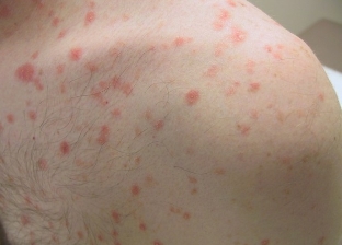 In the first phase psoriasis