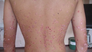 Psoriasis treatment how quickly