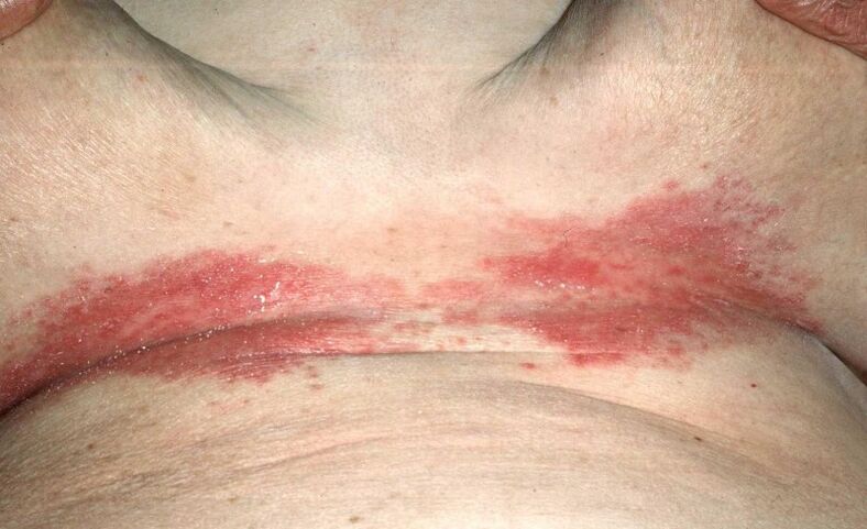 Psoriatic plaques under the breasts