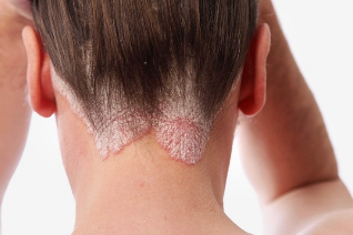 soft skin why psoriasis occurs