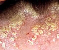 psoriasis of the head photo 1