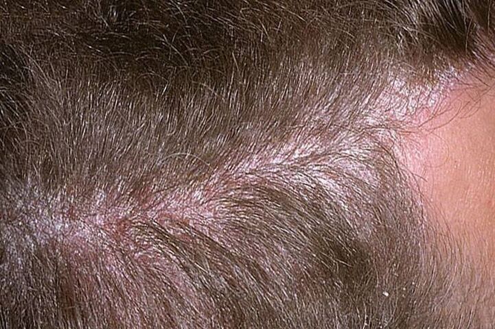 psoriasis of the head photo 3