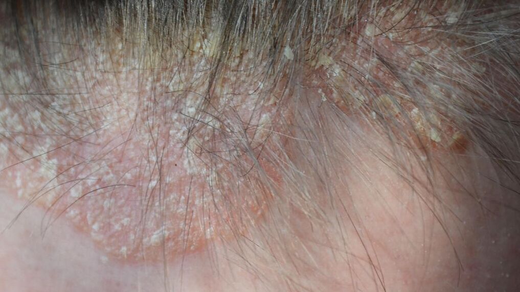 psoriasis of the head photo 4