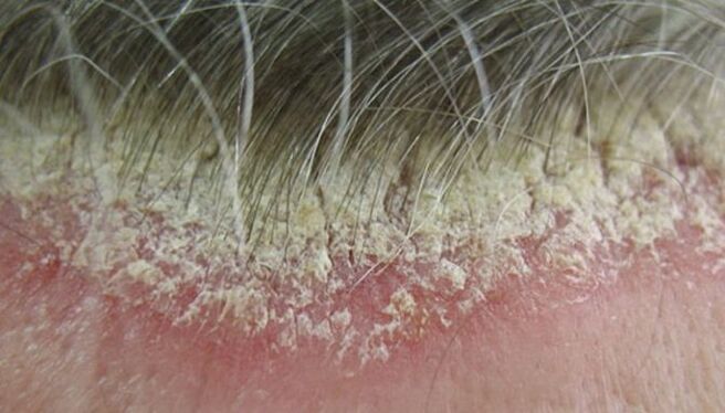 psoriasis of the head photo 5