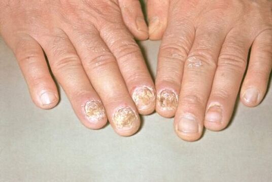 nail psoriasis photo 1