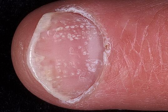 nail psoriasis photo 2