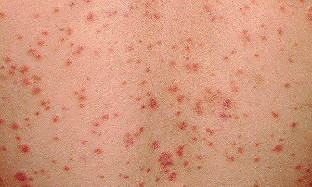 during the initial phase of psoriasis that looks like