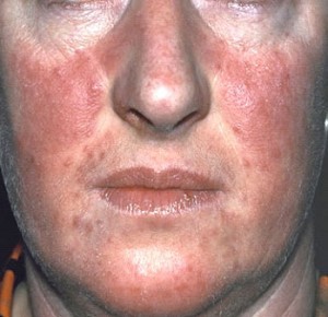face psoriasis treatment more