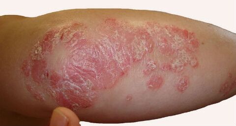 Scaly, bulky plaques on the elbow during a psoriasis flare
