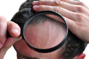 Psoriasis of the head through a magnifying glass