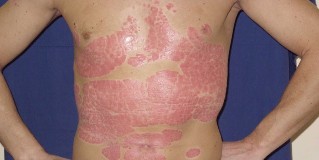 a comprehensive treatment of instructions, psoriasis