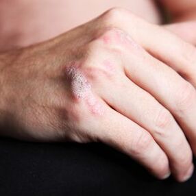 Psoriatic plaque on the hand