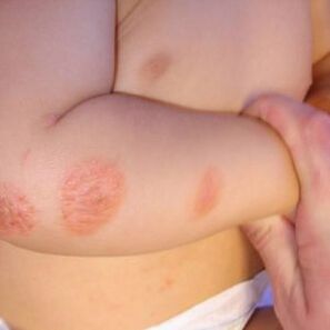Scaly ringworm in a baby
