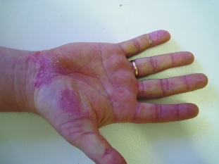 Pustules palms and soles of feet
