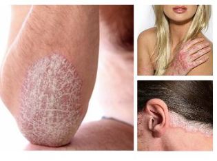 What is psoriasis and how can it be treated