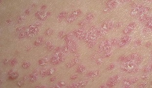 In the first phase psoriasis