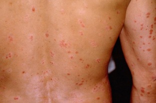 during the initial phase of psoriasis
